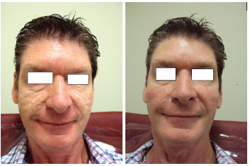 Cheek Fillers - Before & After