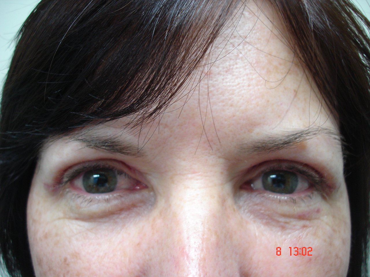 Upper eyelid surgery post