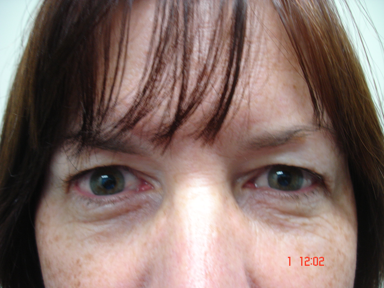 eyelid pre 1