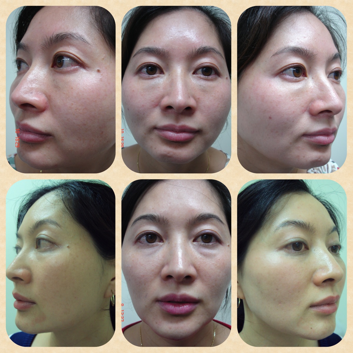 Filler injection into chin performed only for these photo