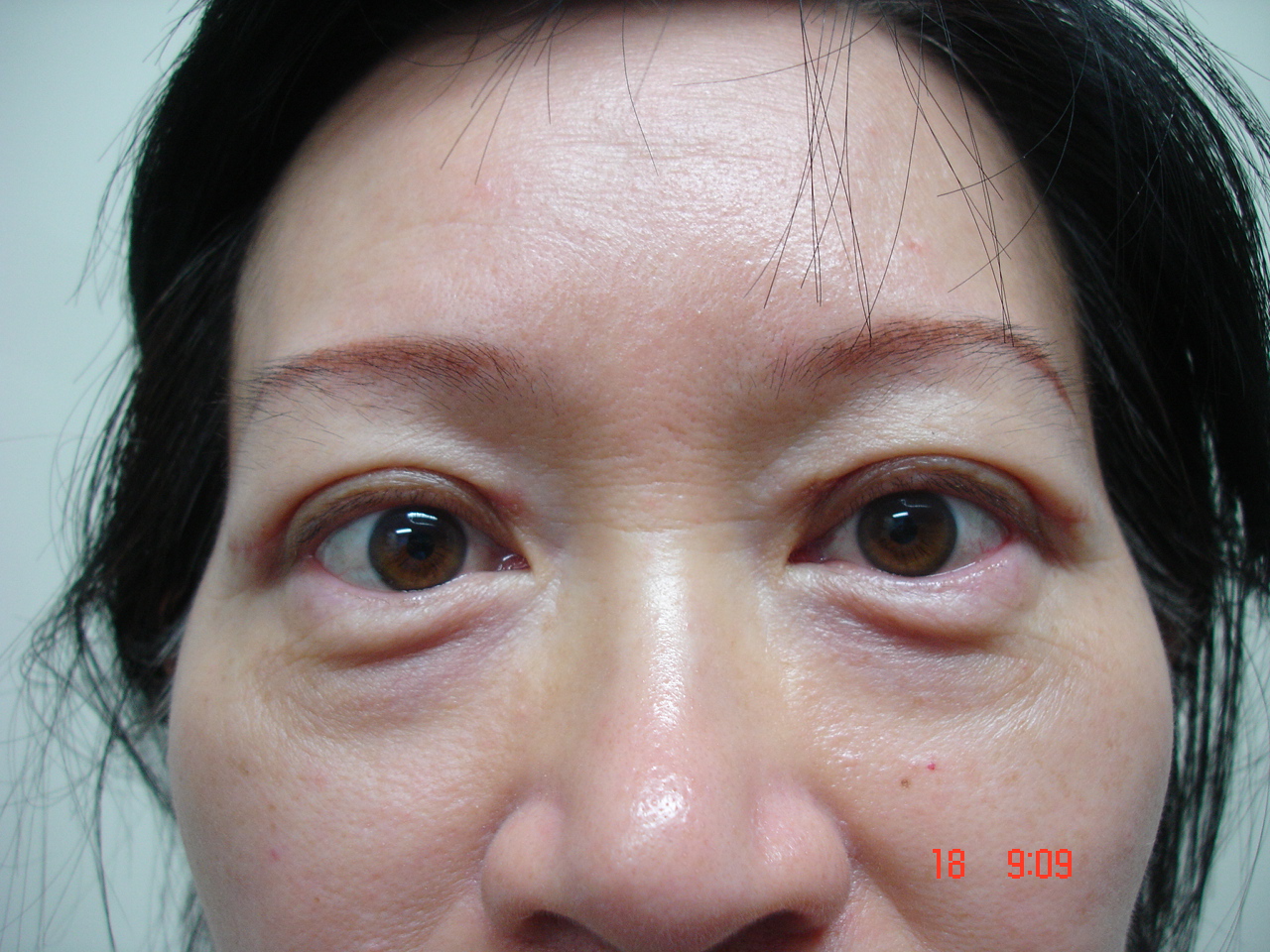 Asian Eyelids Surgery 82