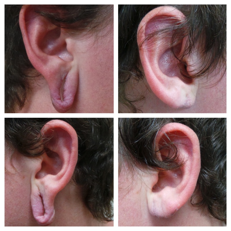Before and after ear lobe repair in Brisbane